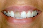 Closeup smile with dark front tooth