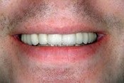 Closeup smile after tooth is replaced