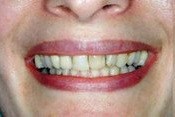 Closeup smile with dark colored front teeth
