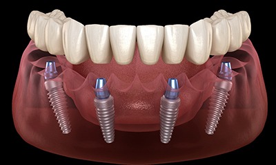 Model of All-On-4 denture