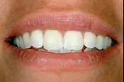 closeup smile with darkened tooth whitened