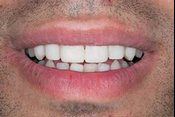 Closeup smile with even spacing