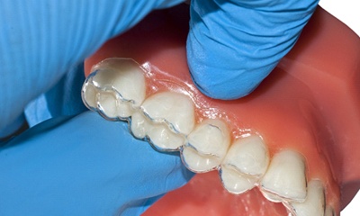 clear aligners on dental mold