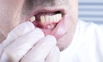 Man with a missing tooth at a consult for a dental bridge in Wethersfield