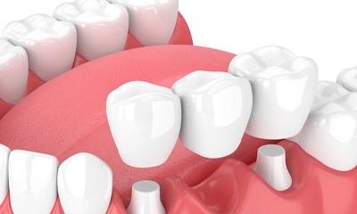 Model of a dental bridge and crowns