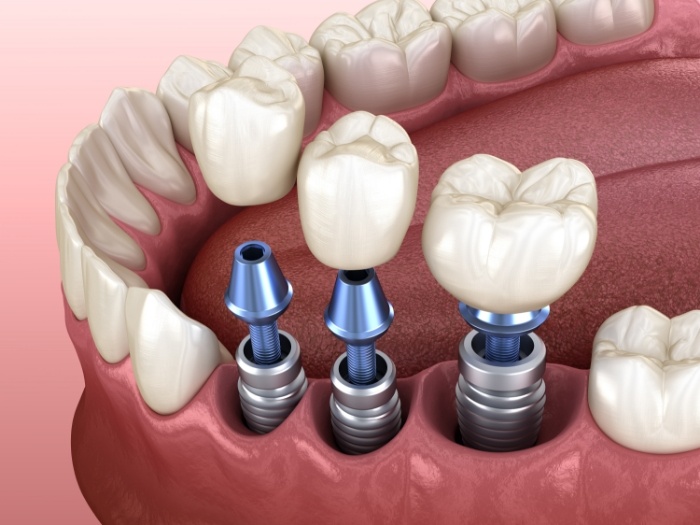 Illustration of multiple dental implants being placed in jaw