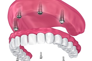 implant denture on the upper arch secured by four dental implants 