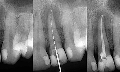 X-ray of inside of teeth