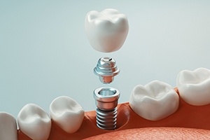 A digital image of a single dental implant and all its parts