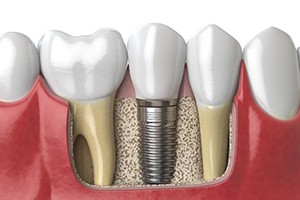 dental implant post in the lower jawbone