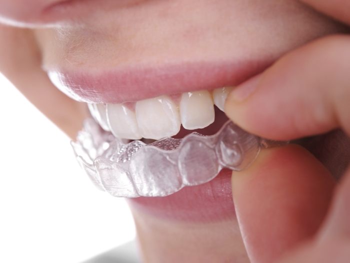 Close-up of woman holding clear aligner