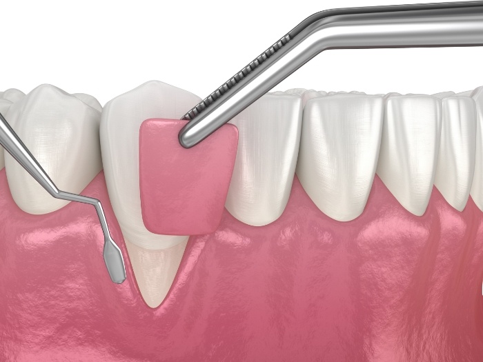 Illustration of soft tissue grafting being performed