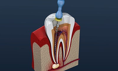 Model of root canal procedure on infected tooth.