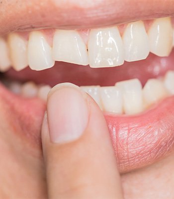 We can repair cavities and broken teeth near Rocky Hill
