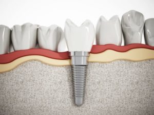 dental implants