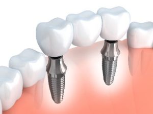 Model of an implant-retained bridge