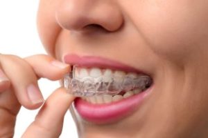 A woman putting in a clear aligner tray 