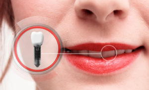 Dental implant in woman's mouth