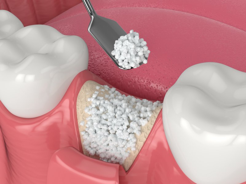 illustration of bone graft procedure in Wethersfield