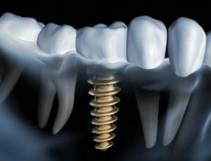 Digital image of dental implant