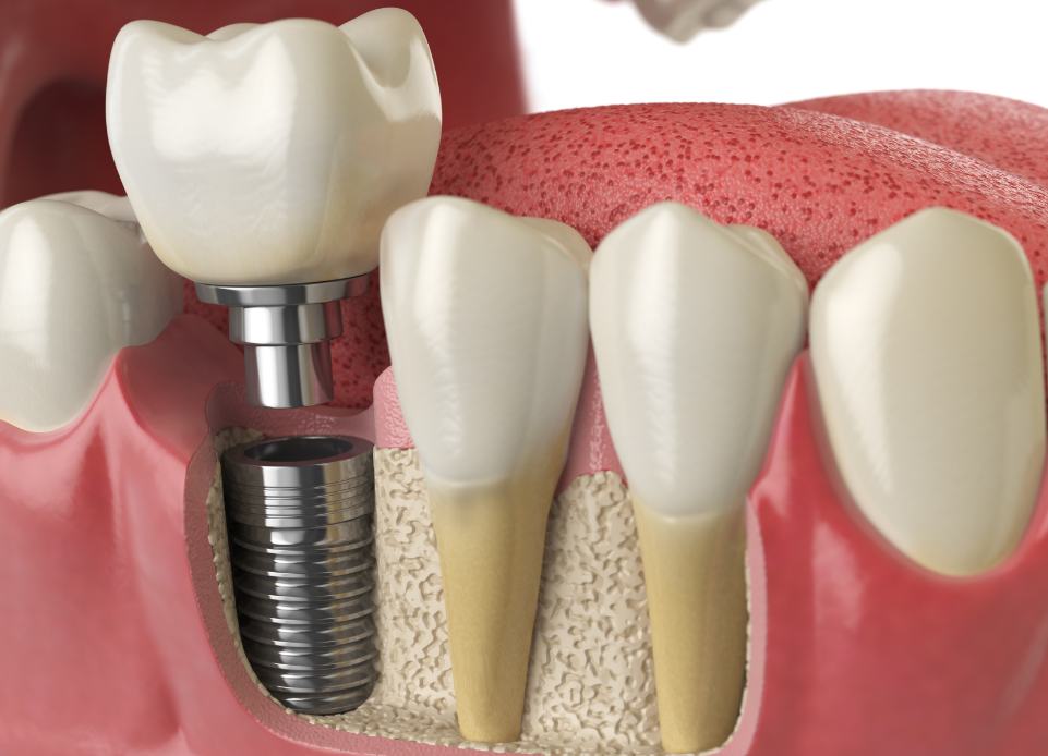 Cross section of dental implants